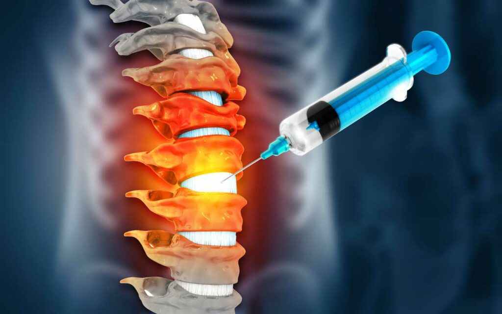 Injektionstherapie an der Wirbelsäule
